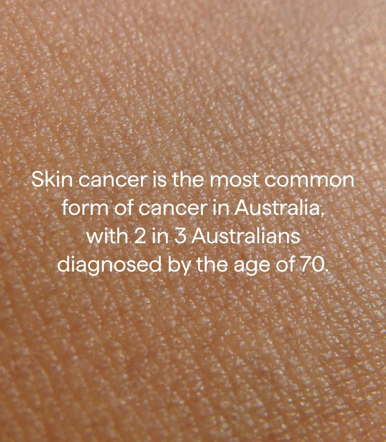 Skin cancer is the most common form of cancer in Australia, with 2 in 3 Australians diagnosed by the age of 70